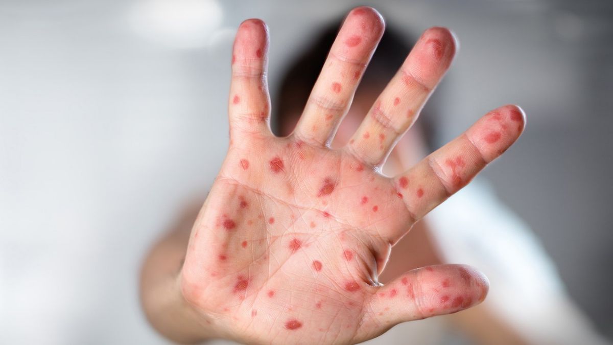 Se disparan casos de viruela del mono