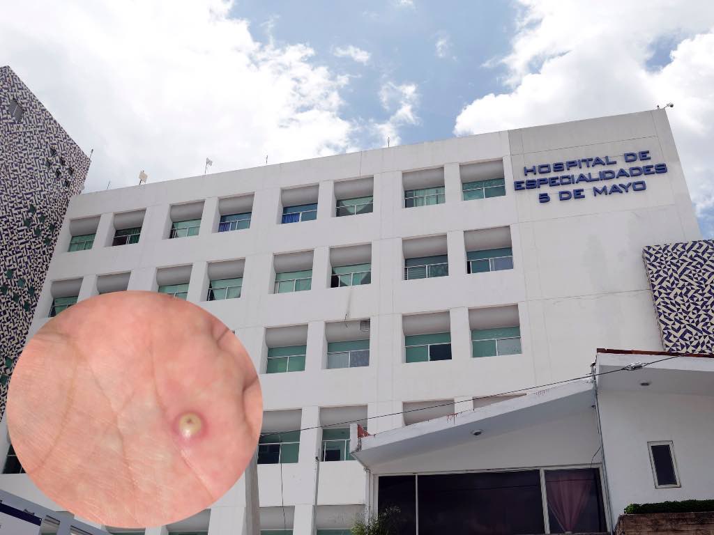 Descartan que en Puebla haya casos de viruela del mono