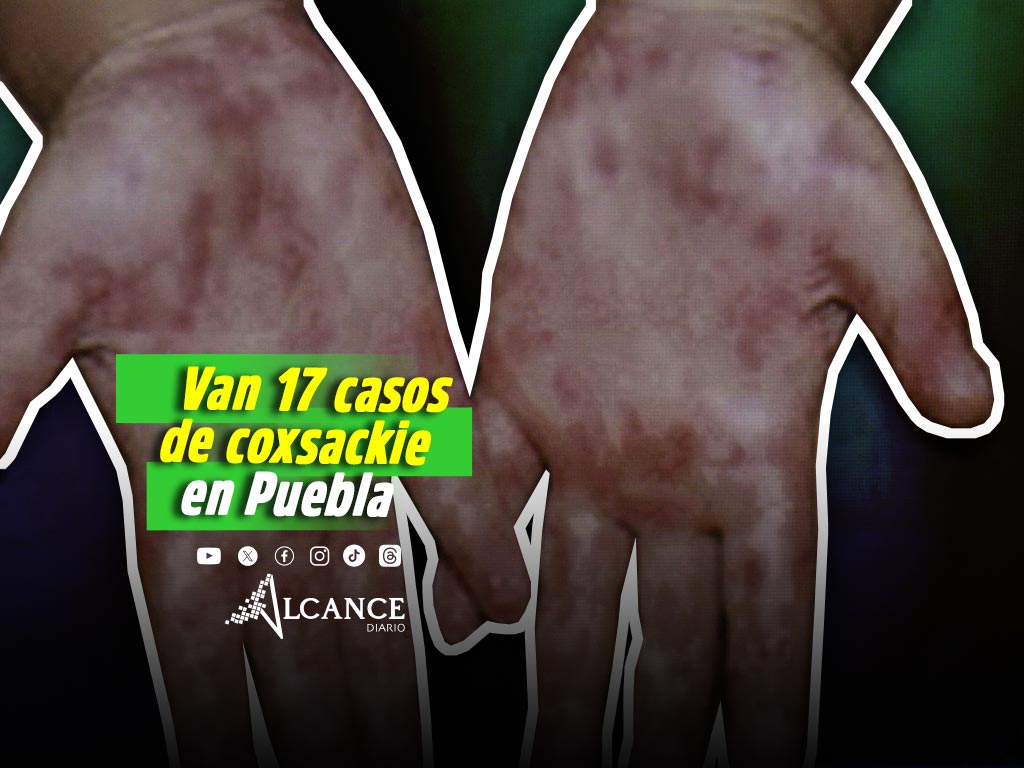 Reportan 17 caso de coxsackie en Puebla 